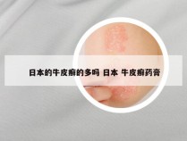 日本的牛皮癣的多吗 日本 牛皮癣药膏