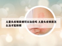 儿童头皮银屑病可以治愈吗 儿童头皮银屑怎么治才能除根