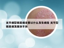 关节病型银屑病主要以什么发生病变 关节型银屑病发展快不快