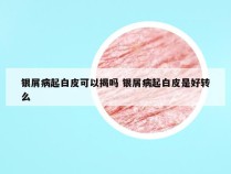 银屑病起白皮可以揭吗 银屑病起白皮是好转么