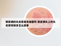 银屑病的头皮屑是有细菌吗 银屑病头上的头皮屑特别多怎么回事