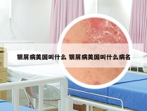 银屑病美国叫什么 银屑病美国叫什么病名