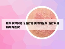 银屑病如何进行治疗比较好的医院 治疗银屑病最好医院