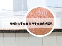 郑州街头牛皮癣 郑州牛皮癣疾病医院