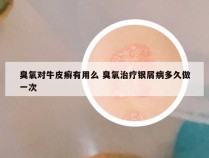 臭氧对牛皮癣有用么 臭氧治疗银屑病多久做一次