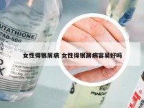 女性得银屑病 女性得银屑病容易好吗