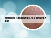 银屑病用擦药期间能洗澡吗 银屑病擦药多久能好