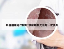 银屑病紫光疗照射 银屑病紫光治疗一次多久