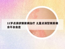 11岁点滴状银屑病治疗 儿童点滴型银屑病会不会自愈
