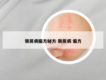 银屑病偏方秘方 银屑病 偏方
