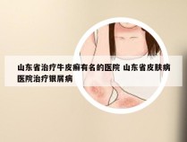 山东省治疗牛皮癣有名的医院 山东省皮肤病医院治疗银屑病