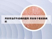 开封市治疗牛皮癣的医院 开封有个看皮肤病的