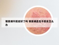 银屑病不脱皮好了吗 银屑病患处不脱皮怎么办