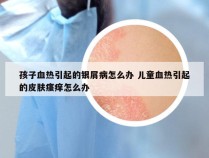 孩子血热引起的银屑病怎么办 儿童血热引起的皮肤瘙痒怎么办