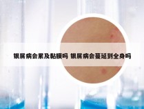 银屑病会累及黏膜吗 银屑病会蔓延到全身吗