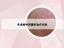 牛皮癣中药最好治疗方剂