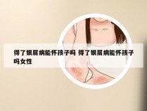 得了银屑病能怀孩子吗 得了银屑病能怀孩子吗女性