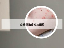 白癜风治疗对比图片