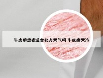 牛皮癣患者适合北方天气吗 牛皮癣天冷