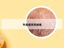 牛皮癣天天掉屑