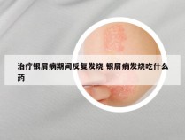 治疗银屑病期间反复发烧 银屑病发烧吃什么药