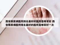 西安银屑病医院排名最好的医院是哪家好 西安银屑病医院排名最好的医院是哪家好一点