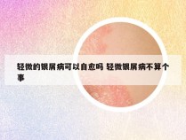 轻微的银屑病可以自愈吗 轻微银屑病不算个事