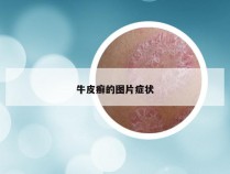 牛皮癣的图片症状