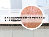 顽固性银屑病用什么药最有效 顽固性银屑病用什么药最有效呢