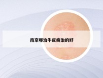 南京哪治牛皮癣治的好