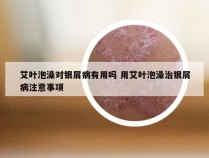 艾叶泡澡对银屑病有用吗 用艾叶泡澡治银屑病注意事项