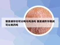 银屑病孕妇可以喝乌鸡汤吗 银屑病怀孕期间可以用药吗