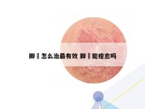 脚廯怎么治最有效 脚廯能痊愈吗