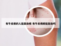 有牛皮癣的人能献血嘛 有牛皮病癣能献血吗