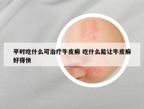 平时吃什么可治疗牛皮癣 吃什么能让牛皮癣好得快