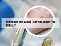 点状性银屑病怎么治疗 点状性银屑病用什么药物治疗
