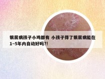 银屑病孩子小鸡都有 小孩子得了银屑病能在1~5年内自动好吗?!