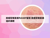 脓疱型银屑病与AGEP鉴别 脓疱型银屑病组织病理