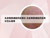 头皮银屑病搽药后发红 头皮银屑病搽药后发红怎么回事