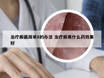 治疗癣最简单8的办法 治疗癣用什么药效果好