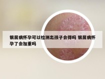 银屑病怀孕可以检测出孩子会得吗 银屑病怀孕了会加重吗