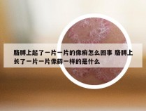 胳膊上起了一片一片的像癣怎么回事 胳膊上长了一片一片像藓一样的是什么