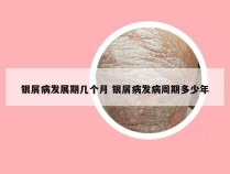 银屑病发展期几个月 银屑病发病周期多少年