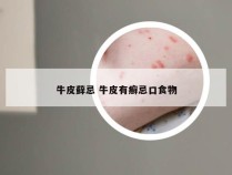 牛皮藓忌 牛皮有癣忌口食物