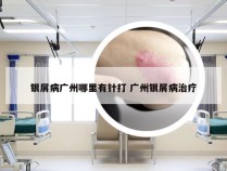 银屑病广州哪里有针打 广州银屑病治疗