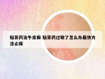 贴膏药治牛皮癣 贴膏药过敏了怎么办最快方法止痒