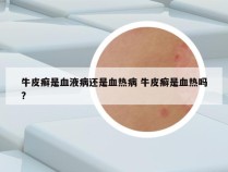 牛皮癣是血液病还是血热病 牛皮癣是血热吗?