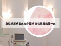 急性银屑病怎么治疗最好 急性银屑病是什么