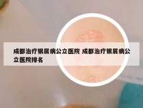 成都治疗银屑病公立医院 成都治疗银屑病公立医院排名