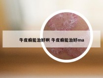 牛皮癣能治好啊 牛皮癣能治好ma